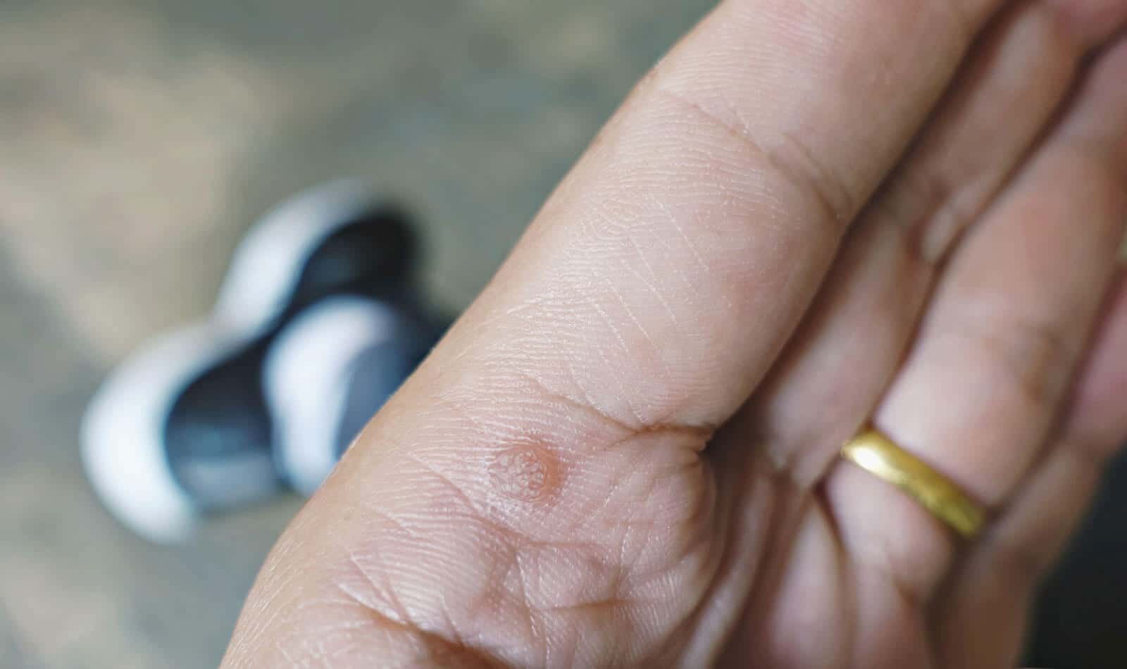 A wart caused by human papillomavirus on a person's hand